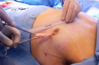 Хирургическое лечение гинекомастии