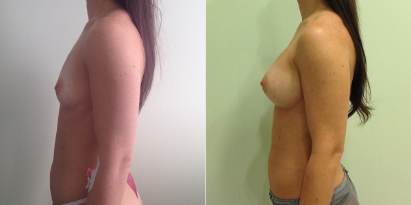 Фото до и после увеличения груди у Светланы Пшонкиной