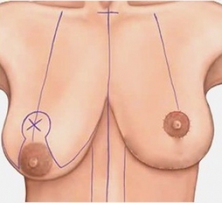 Асимметрия груди