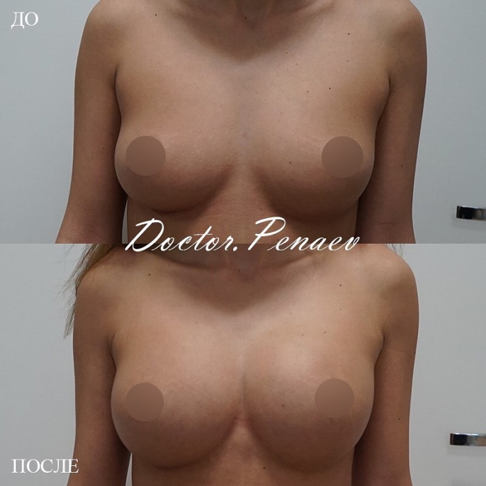 Пациентка пластического хирурга Арслана Пенаева до и после липофилинга груди