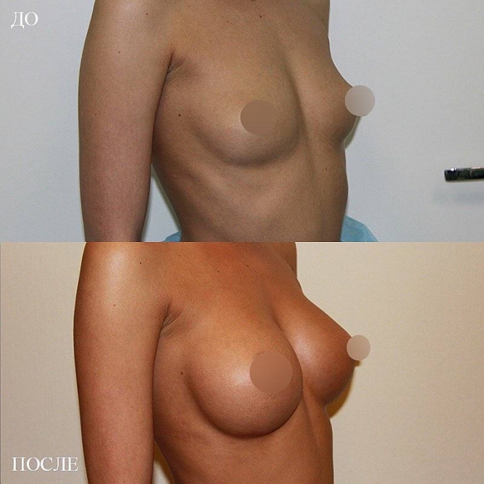 увеличение груди имплантами