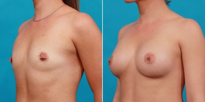 Пациентка доктора Гукаса Миракяна до и после увеличения груди
