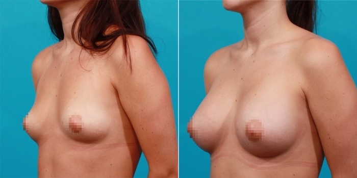 Пациентка доктора Гукаса Миракяна до и после увеличения груди