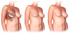Реконструкция груди