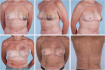 Результаты операции по реконструкции груди