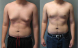 Результат операции по устранению гинекомастии