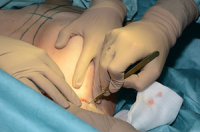 pervaja operacia na omorfii