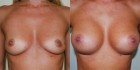 До и после увеличения груди у доктора Гришкяна