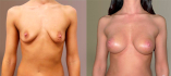 До и после маммопластики бесшовным методом