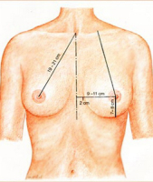 ideal breast