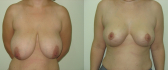 До и после редукционной маммопластики