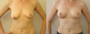 Результат увеличения груди в