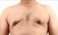 После устранения гинекомастии у Раеда возникли осложнения в виде грубых рубцов