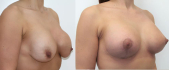Повторная маммопластика в DoctorPlastic