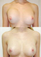 povtornaja mammoplastika