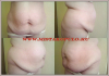 Абдоминопластика с транслокацией пупка - ДО