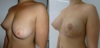Результат устранения асимметрии груди спустя 1 месяц после операции