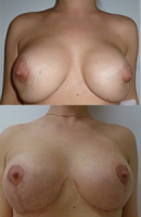 neudachnaja mammoplastika