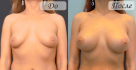 Результат увеличения груди спустя 1 месяц после операции