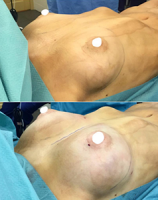 do i posle lipofilinga