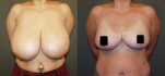 До и после редукционной маммопластики
