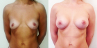 Пациентка Светланы Пшонкиной до и после увеличения груди