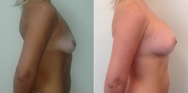 Фото до и после увеличения груди у Светланы Пшонкиной