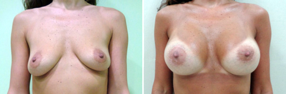 Фото до и после маммопластики у Владимира Косинца