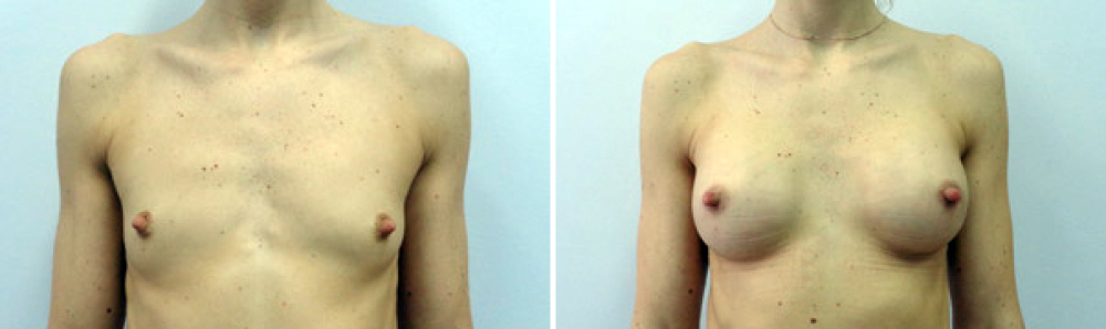 Результаты маммопластики у Владимира Косинца