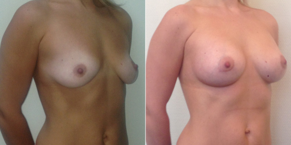 Фото до и после увеличения груди у Светланы Пшонкиной