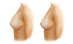 Увеличение груди имплантами