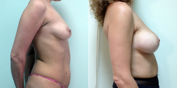 Фото пациентки до и после подтяжки и увеличения груди у Светланы Пшонкиной