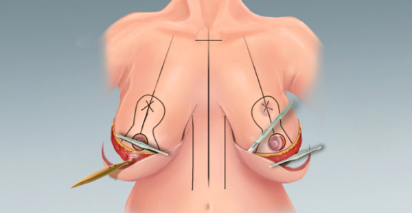 Уменьшение молочных желез