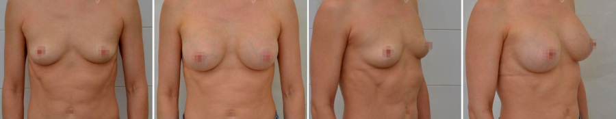 аксиллярный доступ