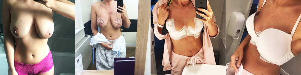 Уменьшение груди фото пациентки