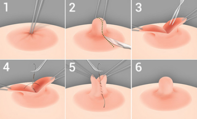 Коррекция втянутого соска