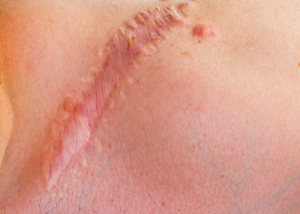 Келоидный шрам после увеличения груди