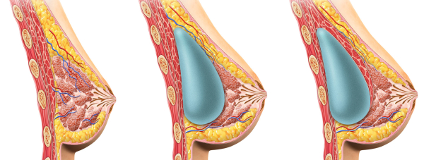 Размещение импланта