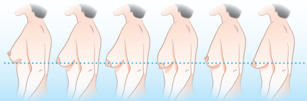 Опущение груди