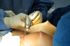 Увеличение и подтяжка груди