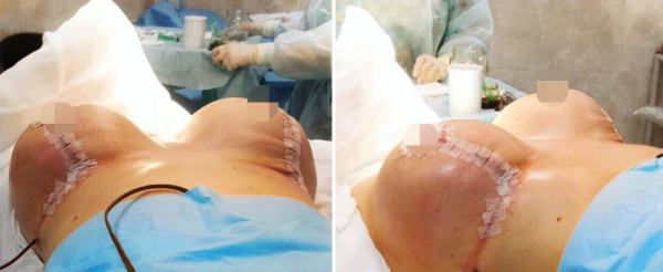 Уменьшение груди Рустем Каримов