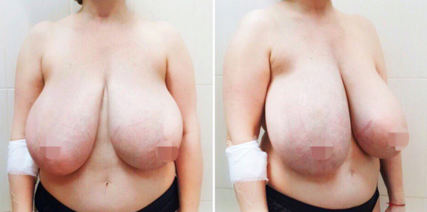 Уменьшение груди Рустем Каримов