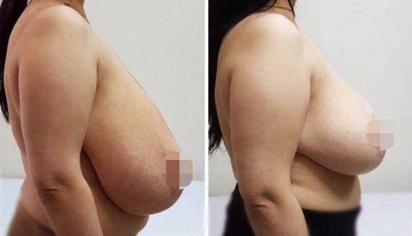 Редукция груди. Рустем Каримов