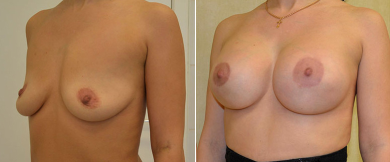 Подтяжка груди на имплантах