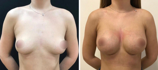 Фархат Мамедов увеличение груди