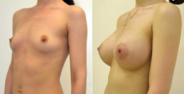 увеличение груди и беременность