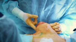 Операция по увеличению груди