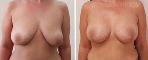 Рустем Каримов подтяжка груди