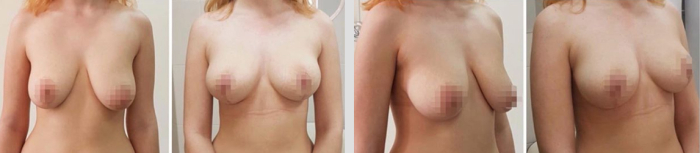 Подтяжка груди Рустем Каримов