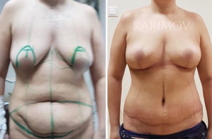 Рустем Каримов увеличение груди и абдоминопластика